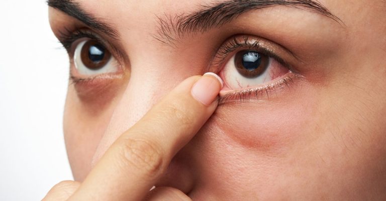 Alerjik Konjonktivit