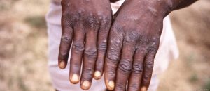 Maymun çiçeği hastalığı hakkında neler biliyoruz?