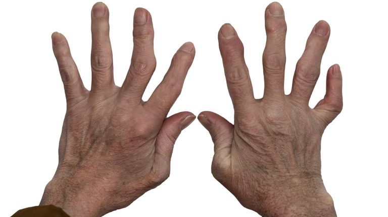 Romatoid Artrit hastalarının yaşamlarına dokunacak platform: Hayat Benim Elimde