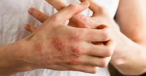 Atopik dermatit hastaları için özgürlüğe yelken açılacak