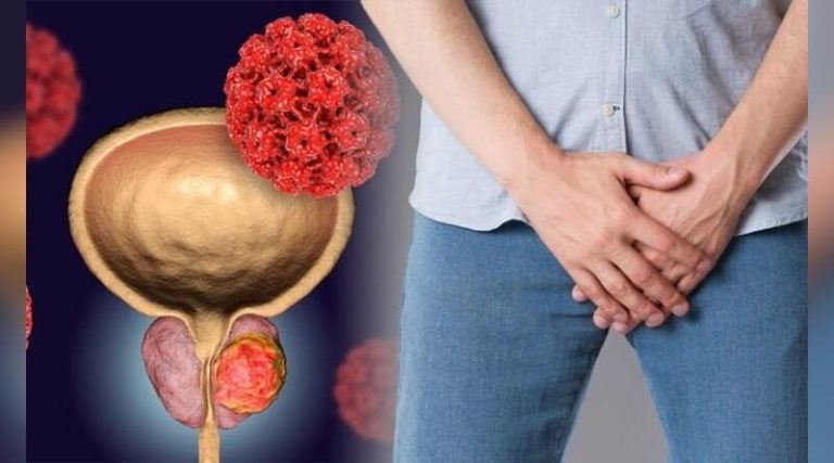 Prostat kanseri Türkiye’de 100 bin erkekten 35’inde görülüyor…