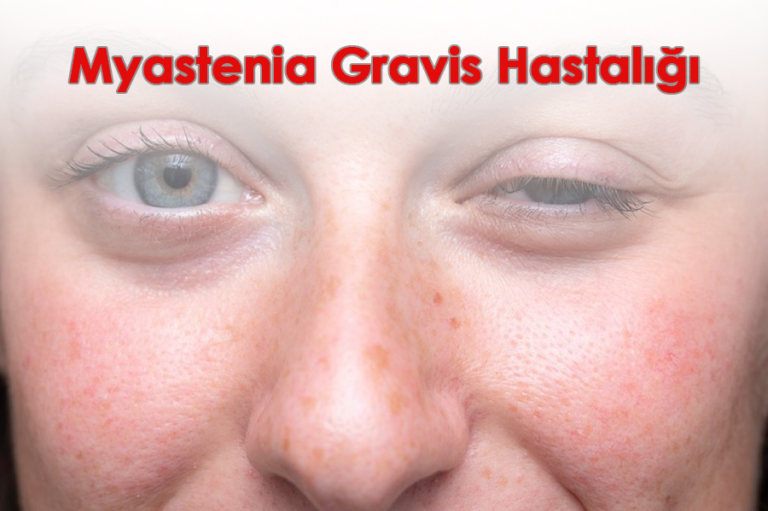 Göz kapaklarında düşüklük ve çift görme, konuşma, yutma güçlüğü, kollar ve bacaklarda oluşan kas güçsüzlüğü