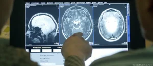 Alzheimer’ın sırrı çözüldü