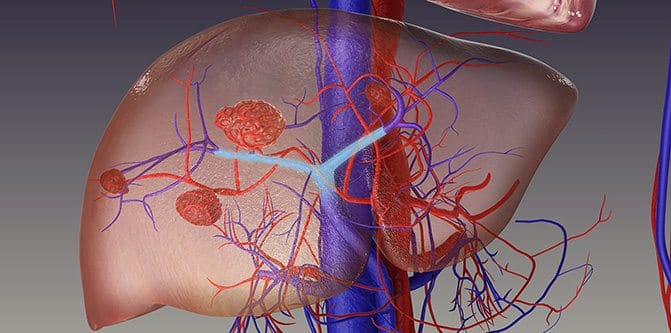En sık görülen karaciğer kanseri türü Hepatoselüler Karsinom’un (HCC) sağlık harcamalarındaki payı yıllık 2 milyar TL’nin üzerinde