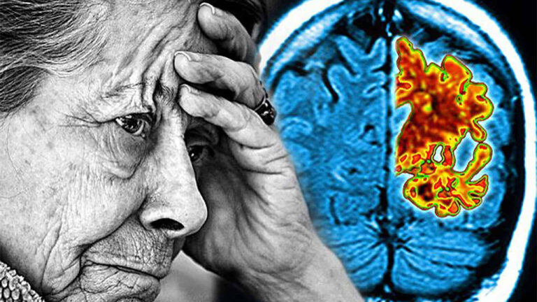 Türkiye’de yaklaşık 800 bin Alzheimer hastası var